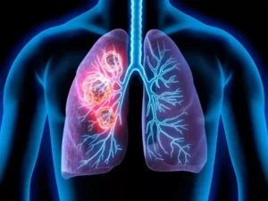 سرطان ریه - تکنوین